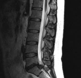 Diagnostinės juosmens osteochondrozės parinktys