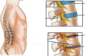 Juosmens osteochondrozės vystymosi priežastys