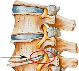 Kodėl juosmens osteochondrozė yra