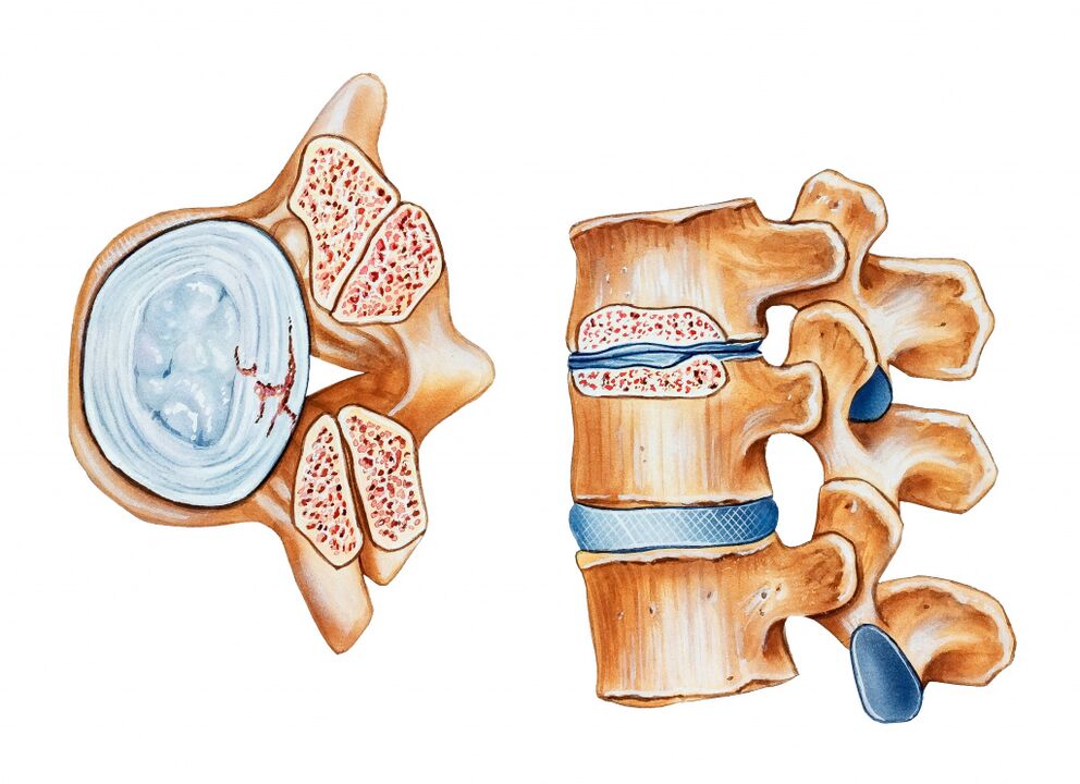 Gimdos kaklelio regiono osteochondrozė sukelia tarpslankstelinių diskų sunaikinimą