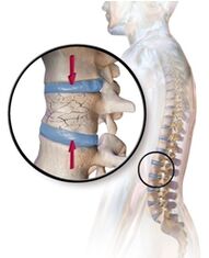 Osteoporozė išprovokuoja nugaros skausmą apatinėje nugaros dalyje