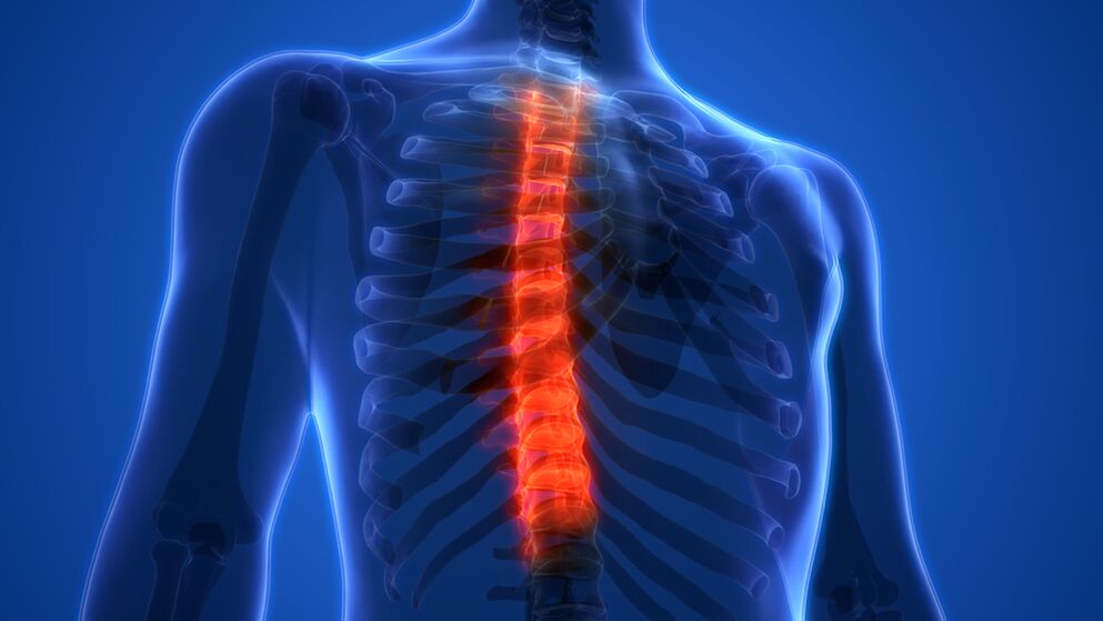 krūtinės ląstos stuburo osteochondrozė